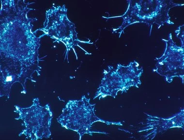 Φλεγμονώδης καρκίνος: Η σπανιότατη μορφή της «επάρατης νόσου» - Δεν εντοπίζεται με μαστογραφία! (φωτό, βίντεο)